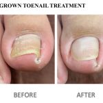 Chiropodist/Podiatrist Ingrown Toenails